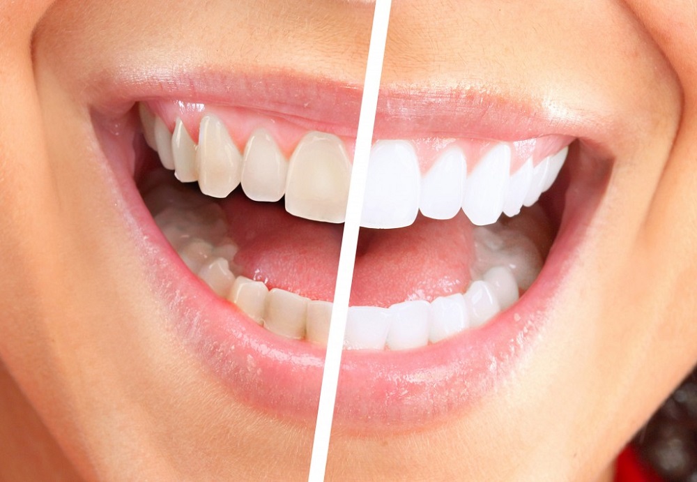 Can A Dental Cleaning Whiten Your Teeth Saskatoon Smiles