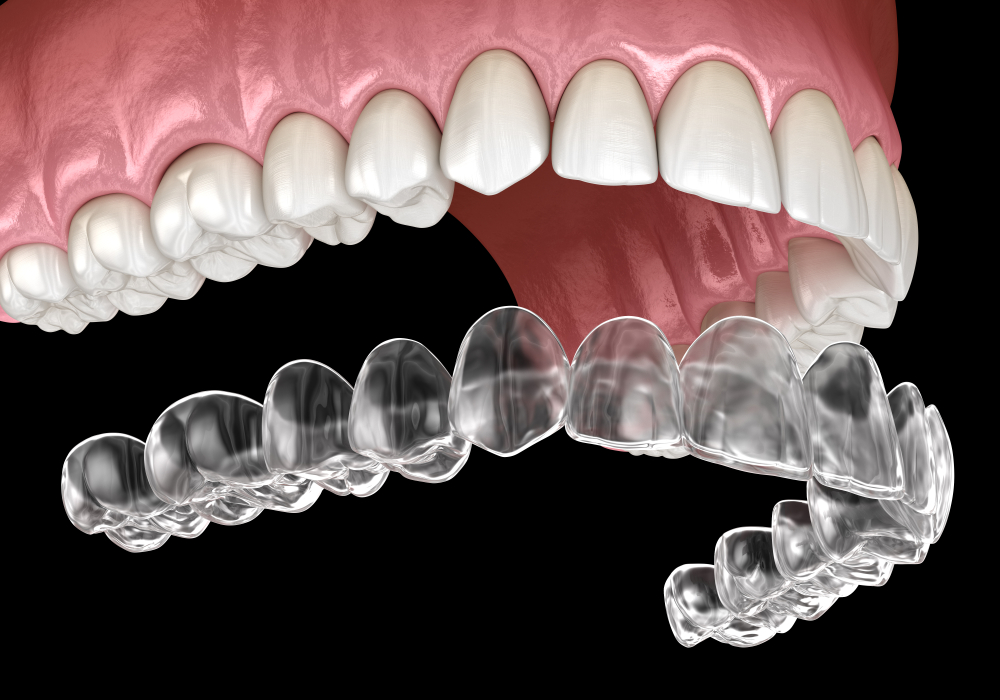 Can You Get Invisalign For Just Your Top Teeth Saskatoon Smiles