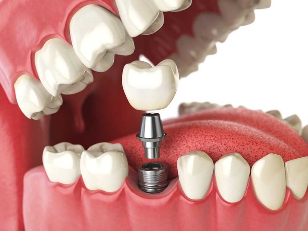 Exploring the Success Rate of Dental Implants