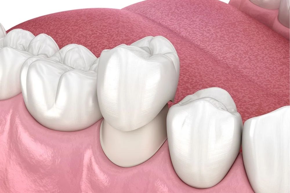 what are dental crowns and are they effective